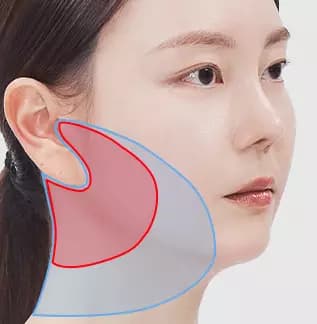 ยกกระชับหน้าส่วนล่างแบบ Semi-Full Facelift