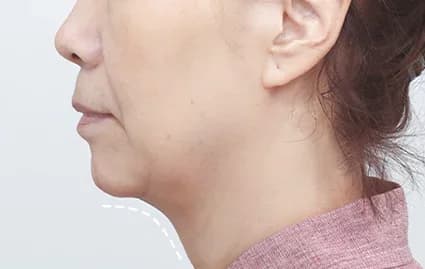 ก่อนผ่าตัด