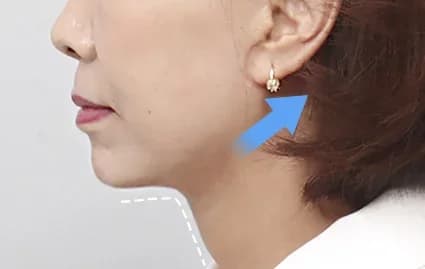 หลังผ่าตัด 2 เดือน