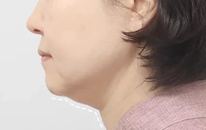 ก่อนผ่าตัด