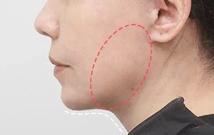 หลังผ่าตัด 1 เดือน