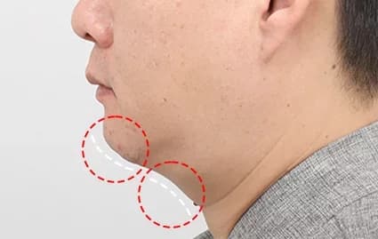 ก่อนผ่าตัด