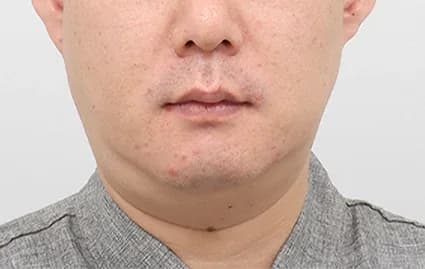 ก่อนผ่าตัด