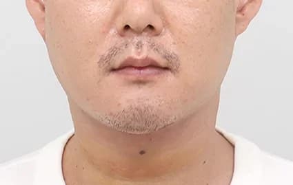 หลังผ่าตัด 1 สัปดาห์