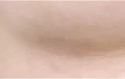 หลังผ่าตัด 3 เดือน