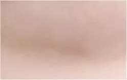 หลังผ่าตัด 10 เดือน