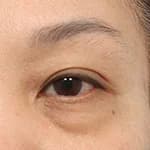 ศัลยกรรมหนังตาบน