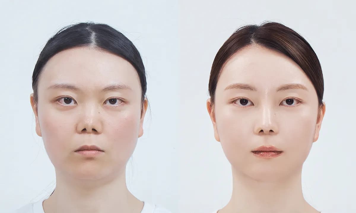 Before and after surgery