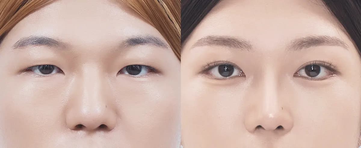 Before and after surgery