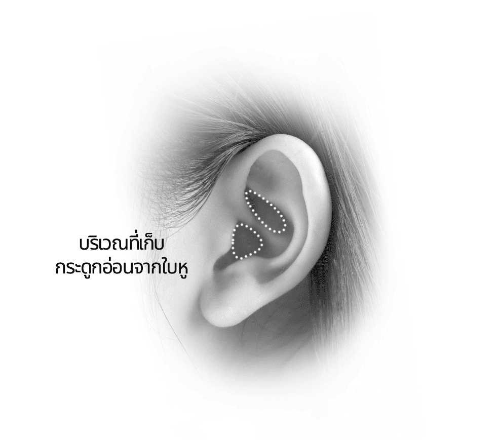 เก็บกระดูกอ่อนจากใบหู