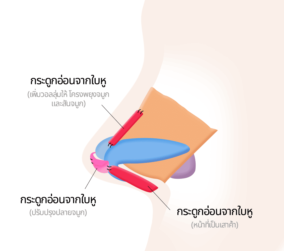 แก้ไขปลายจมูก ฐานจมูกและสันจมูกด้วยกระดูกอ่อนจากใบหู