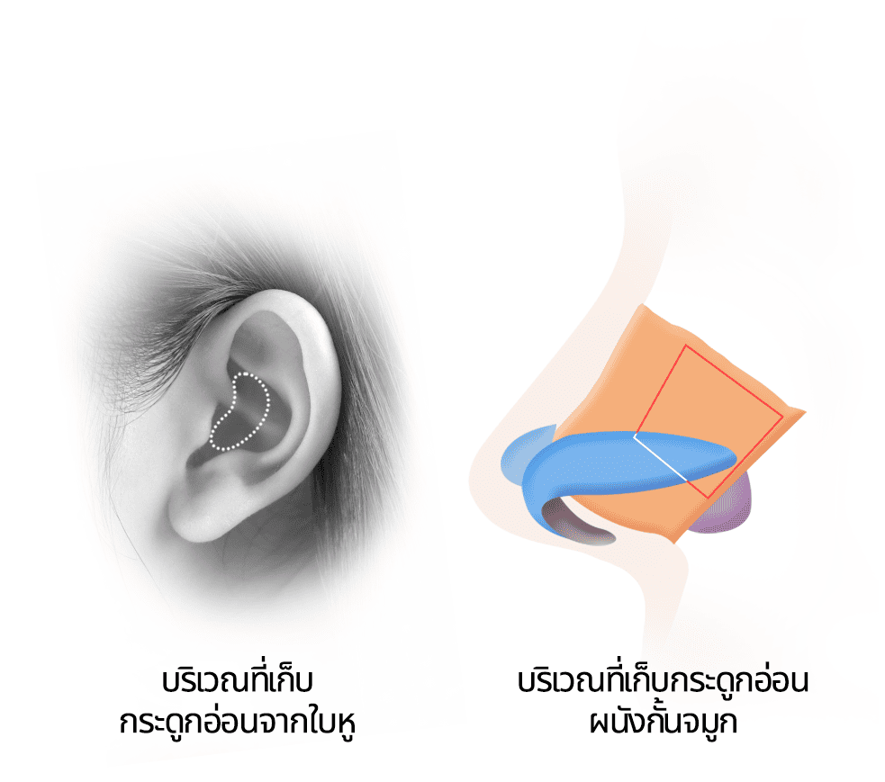 เก็บกระดูกอ่อนจากใบหูและกระดูกอ่อนผนังกั้นจมูก