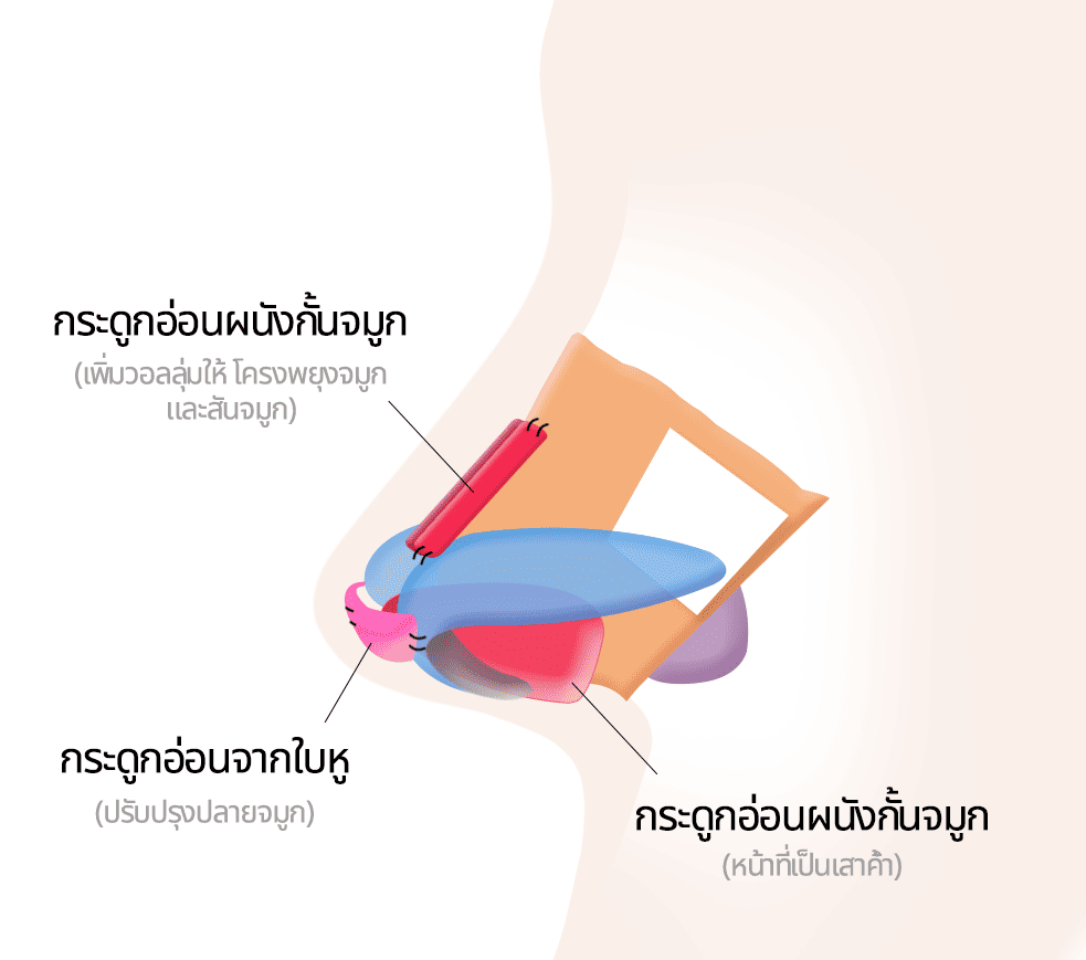 แก้ไขจมูกโดยใช้กระดูกอ่อนใบหูและกระดูกอ่อนผนังกั้นจมูก