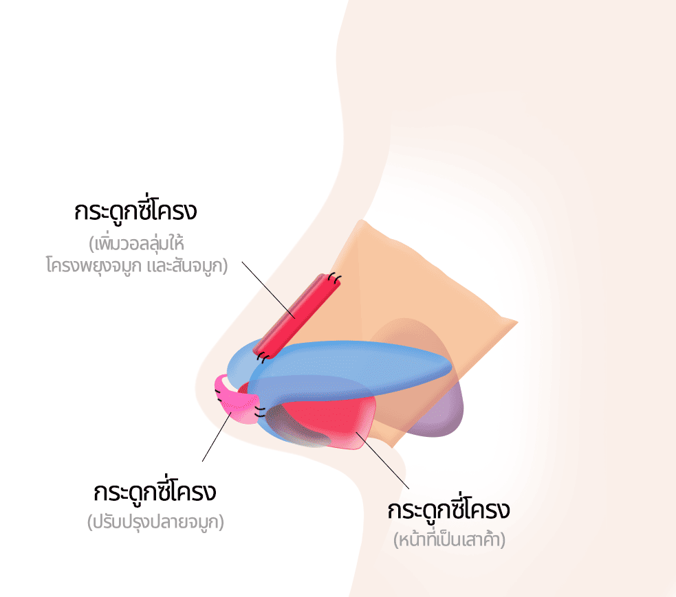 แก้ไขจมูกโดยใช้กระดูกซี่โครง
