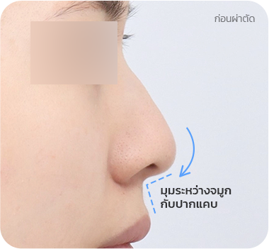 CASE 1. มุมระหว่างจมูกกับปากแคบ before