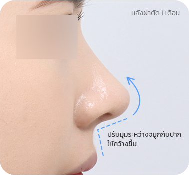CASE 1. มุมระหว่างจมูกกับปากแคบ after
