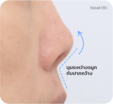 CASE 2. มุมระหว่างจมูกกับปากกว้าง before