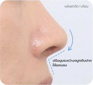 CASE 2. มุมระหว่างจมูกกับปากกว้าง after