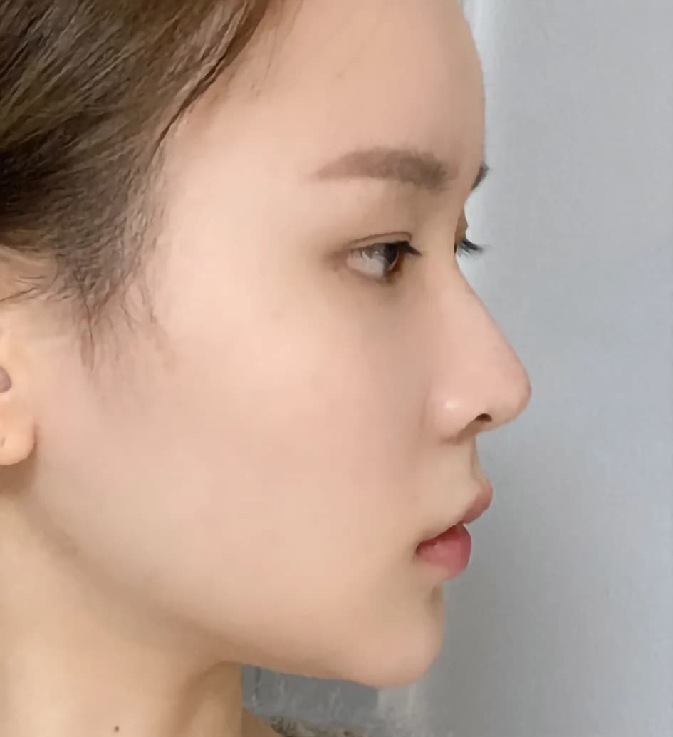 NaturGlow nose tip before