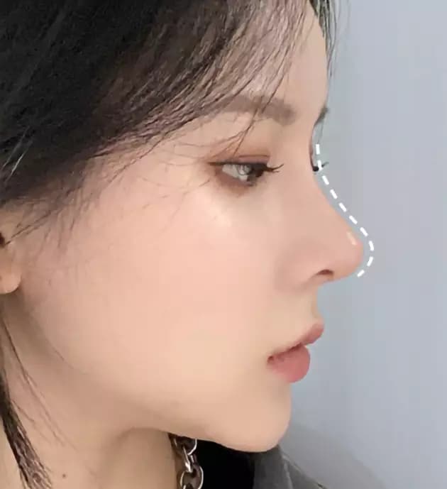 NaturGlow nose tip after