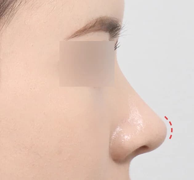 ปลายจมูกสวยโดดเด่น after