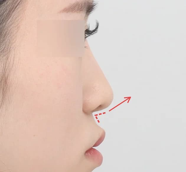 สร้างมิติให้ใบหน้าดูดีมีระดับ
ด้วยองศาปลายจมูก–มุมริมฝีปาก before