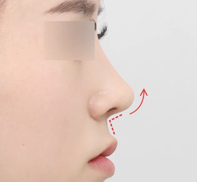 สร้างมิติให้ใบหน้าดูดีมีระดับ
ด้วยองศาปลายจมูก–มุมริมฝีปาก after