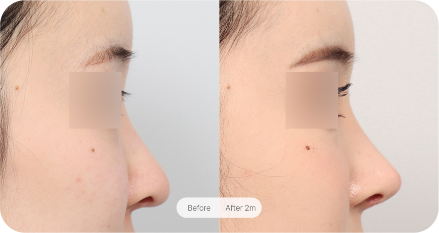 revision-rhinoplasty