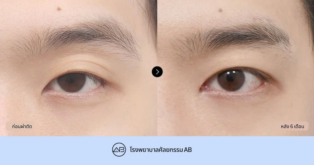 ตัวอย่างก่อน–หลังศัลยกรรมตาผู้ชาย จากดวงตาที่ดูอึดอัดและง่วงซึม สู่ดวงตาที่ดูสดใสและมีมิติยิ่งขึ้น