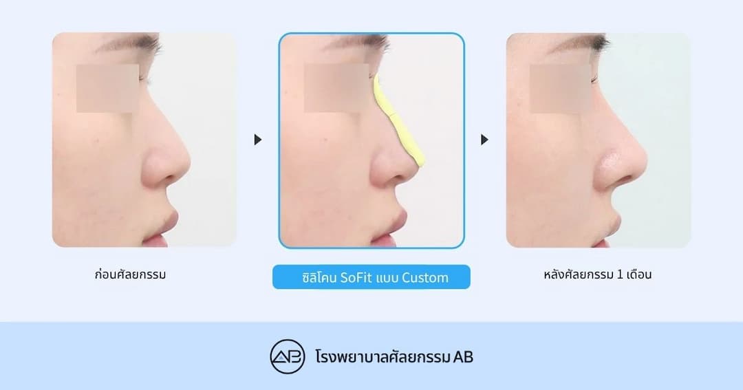 ศัลยกรรมจมูก SOFIT แตกต่างจากการศัลยกรรมจมูกทั่วไปอย่างไร? ใครบ้างที่เหมาะกับการศัลยกรรมจมูกด้วยวัสดุที่ออกแบบเฉพาะบุคคล