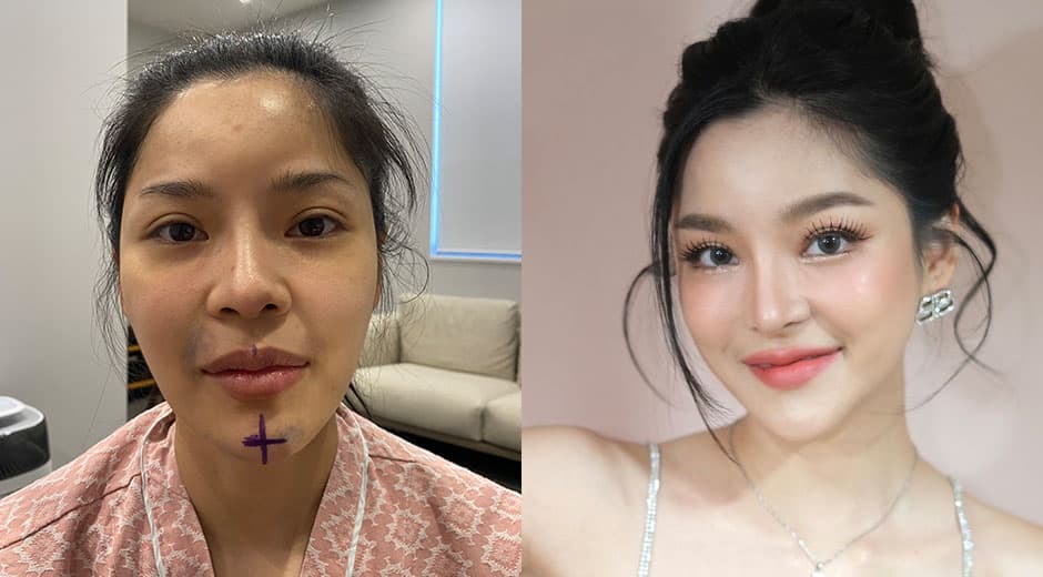 ผู้เชี่ยวชาญด้านศัลยกรรมโครงหน้า 3 จุด !✨ ที่เอบี...เท่านั้นนนน