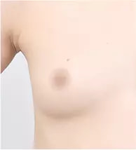 ก่อนผ่าตัด