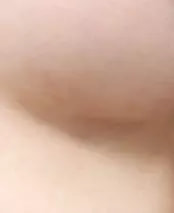 หลังผ่าตัด 2 เดือน แผลผ่าตัดใต้ราวนม