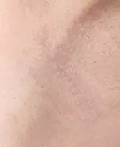 แผลใต้รักแร้ หลัง 2 เดือน