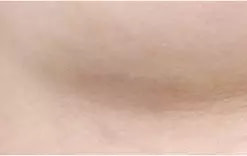 หลังผ่าตัด 3 เดือน