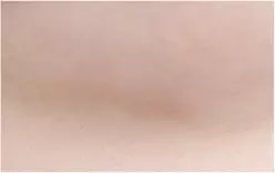 หลังผ่าตัด 10 เดือน