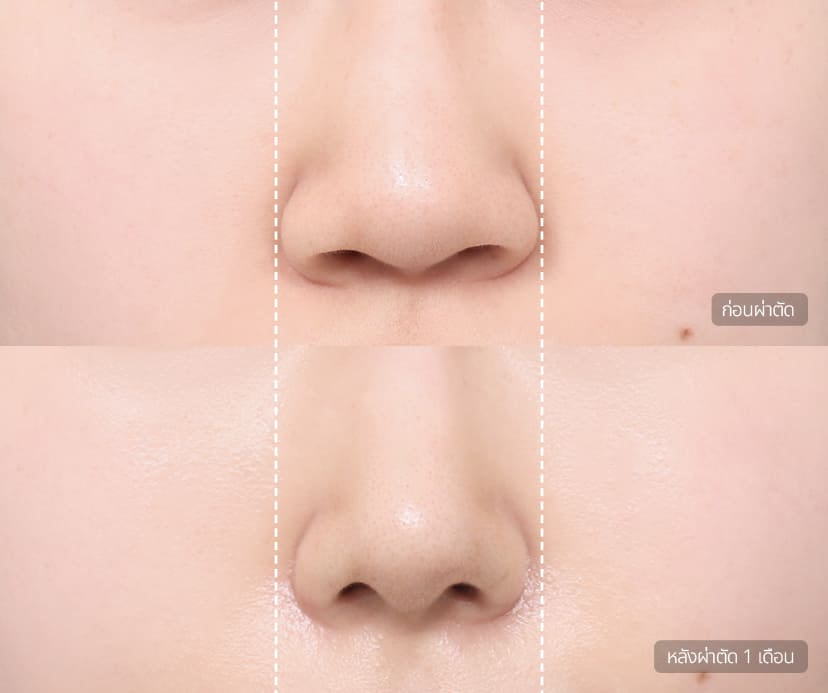 ศัลยกรรมลดปีกจมูก