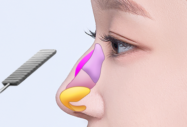 High hump nose surgery — step 1