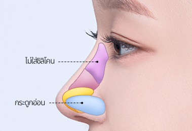 High hump nose surgery — step 2
