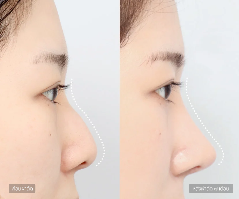 Hump Nose Rhinoplasty