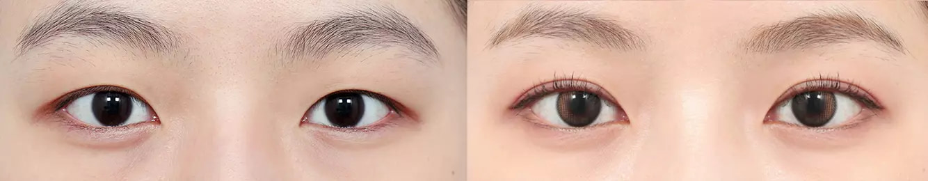 ABC point before and after case 2