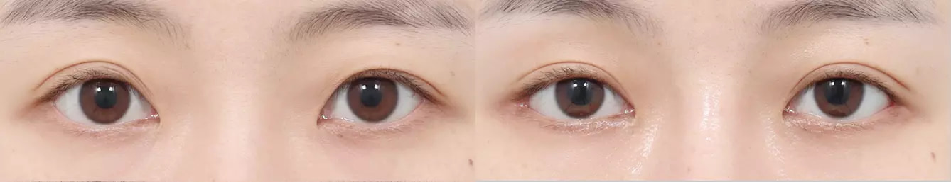 ABC point before and after case 4