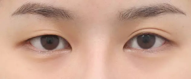 Before translucent adhesion eye surgery