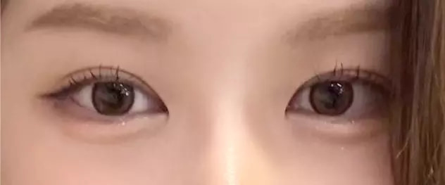 11 months after translucent adhesion eye surgery
