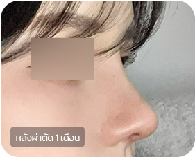 Before and after 2-2