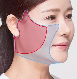 ยกกระชับใบหน้าแบบ Full SMAS Facelift