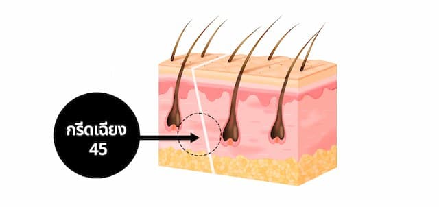 45-degree diagonal incision
