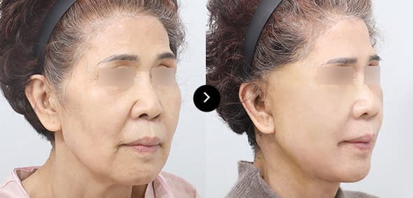 Full SMAS Face Lifting image 1