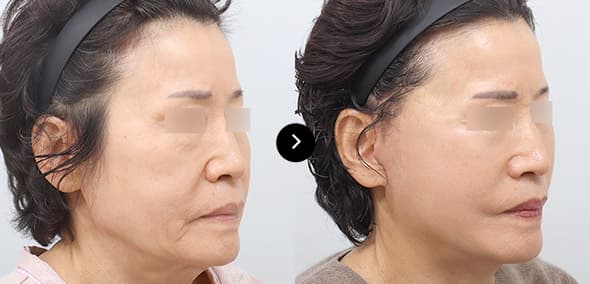 Full SMAS Face Lifting image 2