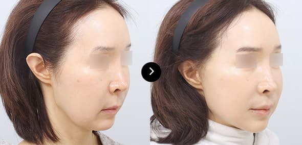 Full SMAS Face Lifting image 5